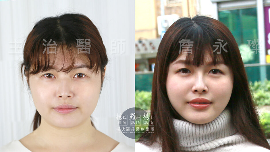 瘦臉 瘦下巴 雕塑 雷射減脂